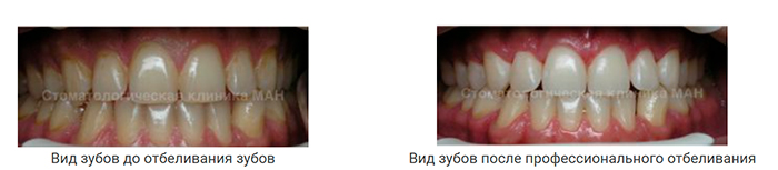 Отбеливание зубов